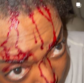 Actress, Helen Duru Left With A Fractured Skull And Covered In Blood After Allegedly Being Attacked By EFCC Operatives